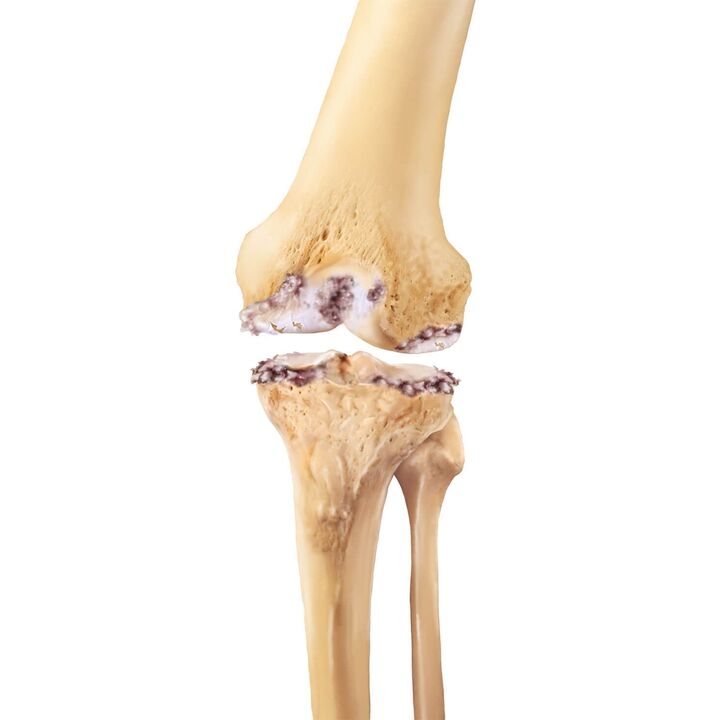 destruição da articulação do joelho com artrose