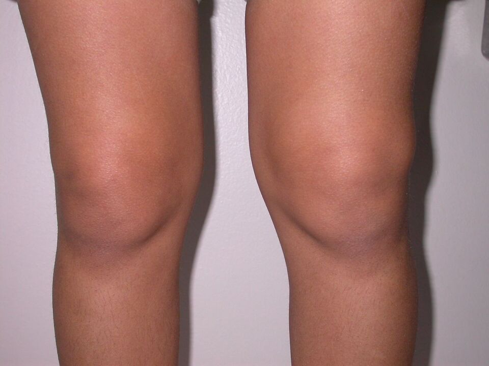 inchaço do joelho devido à osteoartrite