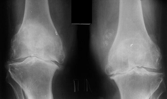 Raio X como uma maneira de diagnosticar a artrose da articulação do joelho