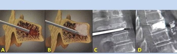 vertebroplastia por punção para dor nas costas