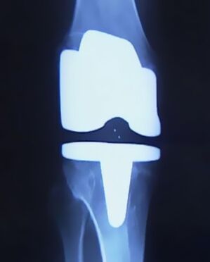 Radiografia de joelho com prótese artificial após cirurgia de substituição articular