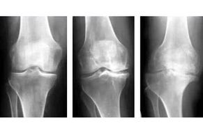 estágios de artrose da articulação em um raio-x