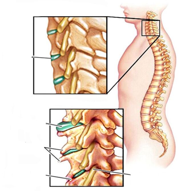 osteocondrose e coluna cervical saudável