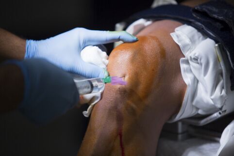 Injeções na articulação do joelho para artrose