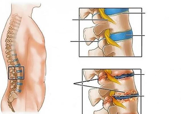 osteocondrose da coluna lombar causa dor nas costas